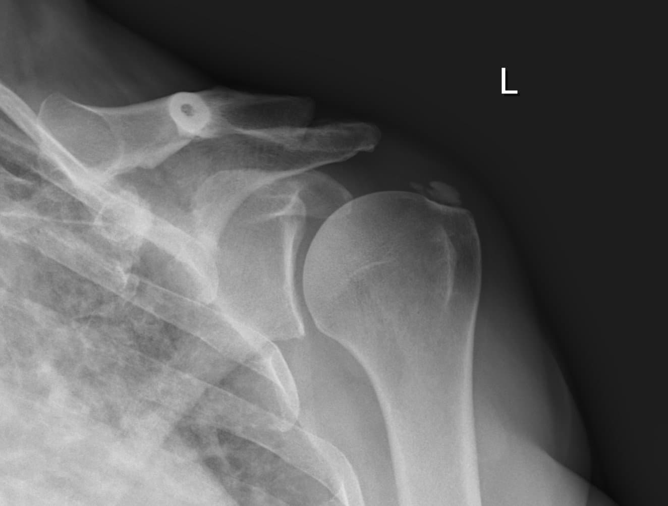 Calcific tendonitis