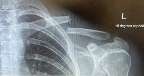 Clavicle fracture